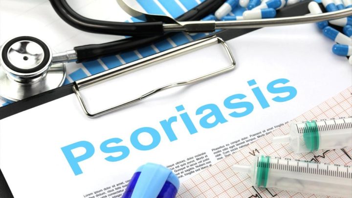 Quel traitement naturel pour le psoriasis ?