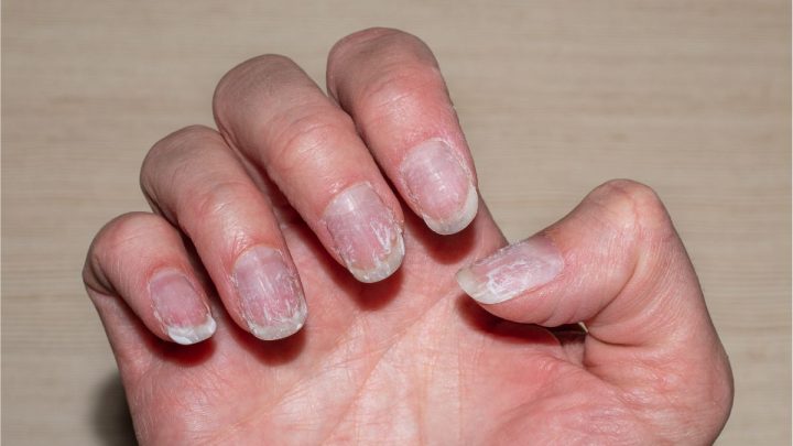Comment prévenir et traiter les ongles abîmés par le vernis à ongles ?