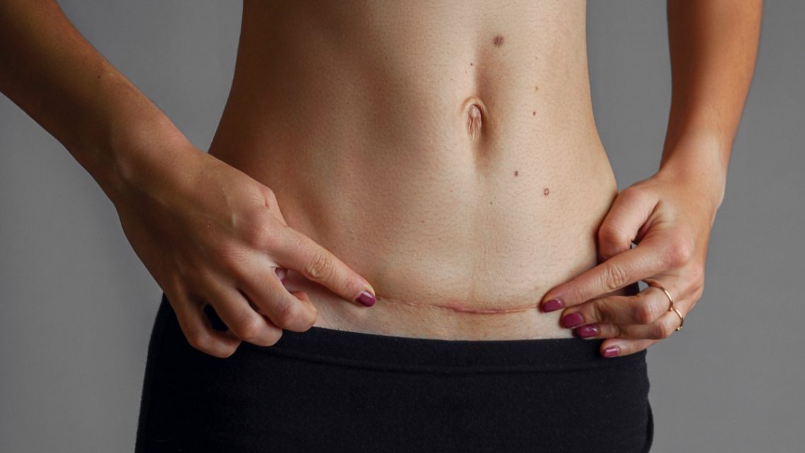 Traitement des cicatrices : les approches modernes