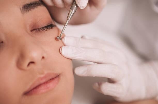 Les meilleurs ingrédients pour dissoudre les points noirs (acide salicylique, argile)